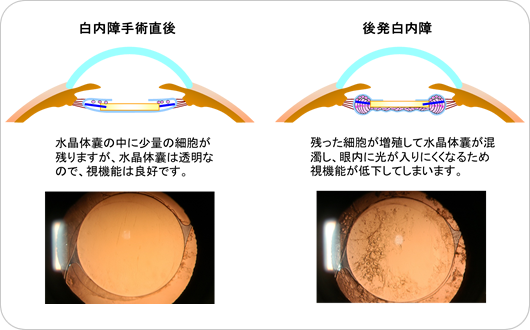 後 いつまで 目薬 手術 白内障