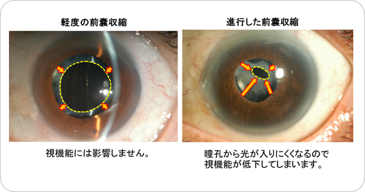 手術 の 白内障 後遺症 後