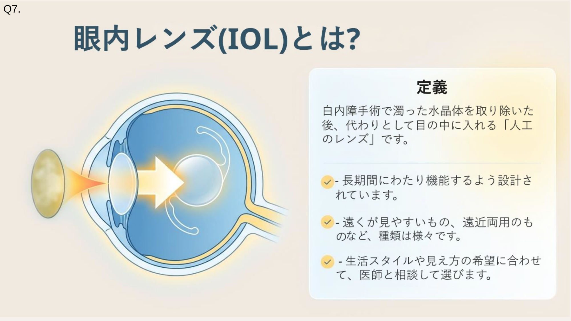 眼内レンズ(IOL)とは?